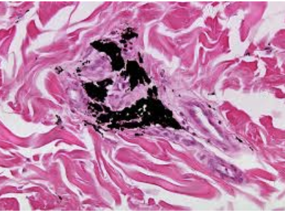 <ol><li><p>Sickle Cell Anemia</p></li><li><p>Atherosclerosis</p></li><li><p>Adenocarcinoma of Kidney</p></li><li><p>Osteogenic Sarcoma of Bone</p></li><li><p>Tattoo in Human Skin</p></li><li><p>Neurilemmoma</p></li><li><p>Anthracosis of the Lung</p></li><li><p>Basal Cell Carcinoma</p></li><li><p>Lung</p></li><li><p>Skeletal</p></li><li><p>Kidney</p></li><li><p>Neuron</p></li><li><p>Skin</p></li><li><p>Blood</p></li><li><p>Bone</p></li><li><p>Aorta</p></li></ol><p></p>