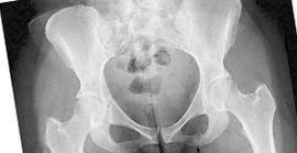 <p><span style="color: red;"><strong>Pubic ramus BSI</strong></span></p>