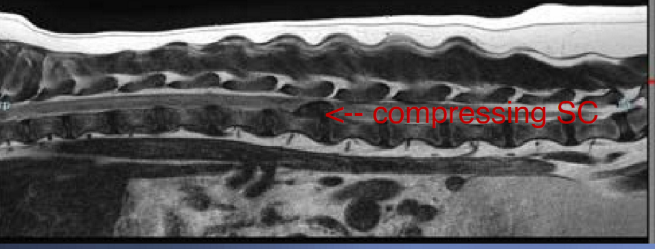 <p>1: mainly small breed, chondrodystrophic dogs (bc they have chondroid/cartilage degen that starts <1 y/o; esp dachsunds &amp; pekingese), usually >2 y/o, avg age is 6 y/o</p><p>.</p><p>2: ACUTE or chronic w/ acute worsening back pain + <strong>sudden onset</strong> of paralysis/paresis</p><p>.</p><p>3: thoracolumbar (AKA back) pain, prop ataxia, prop deficits, paraplegia, ± intact nociception, ± non-ambulatory paresis, ± urinary incontinence</p><p>.</p><p><em>note: commonly occurs in discs between t11/l3 (around lumbosacral junction)</em></p>