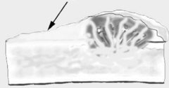<p>What is the smooth periosteal reaction at the edge of an aggressive lesion?</p>