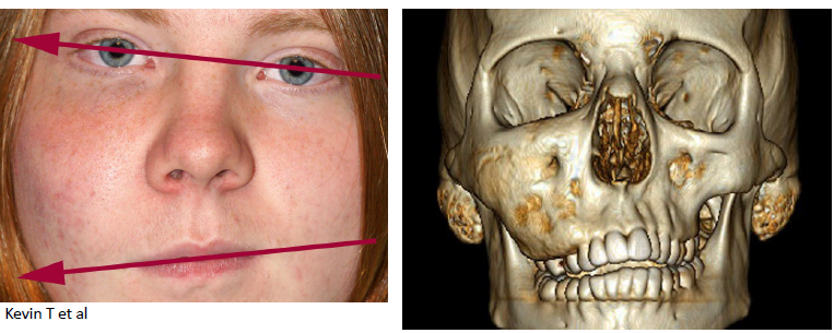 <p>fibrous dysplasia</p>
