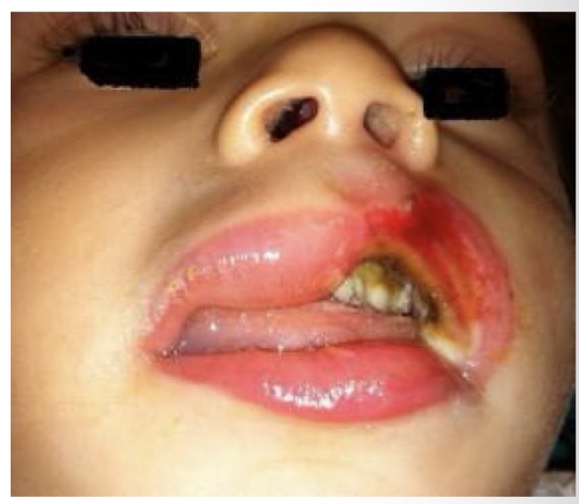 <p>BN 6y</p><p>Vết loét sâu</p><p>CHẨN ĐOÁN?</p>