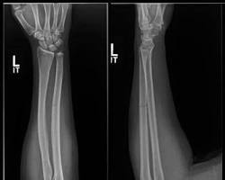 <p>What bandaging technique should be used for this injury?</p>