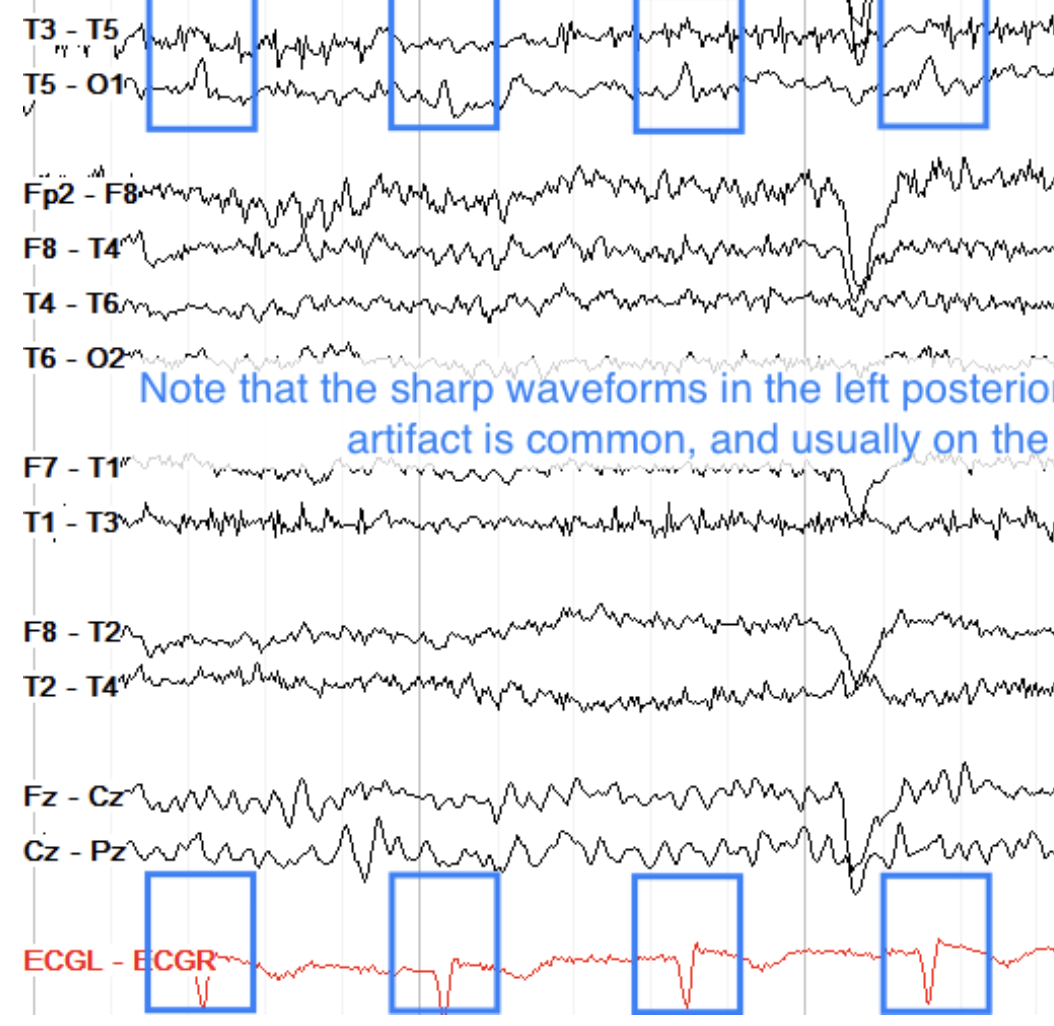 <p>Time locked to QRS. MOSTLY ON LEFT.</p>