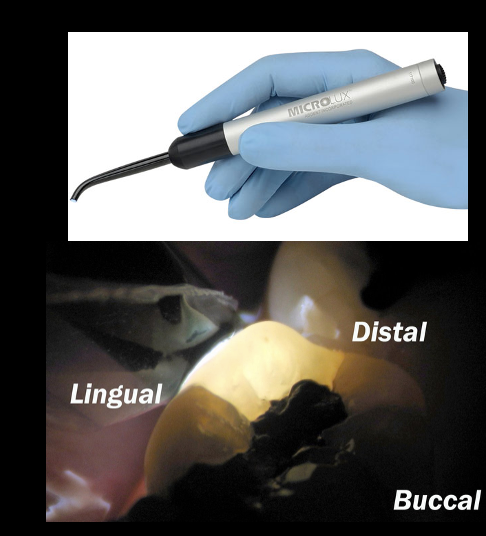 <p>transmitting a beam of light penetrating through tooth structure until it meets a space (in this case, a fracture) that reflects the light beam from the crack plane </p>