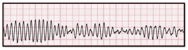 <p>Identify the above waveform:</p><p>a. Torsades</p><p>b. V fib</p><p>c. A fib</p><p>d. V fib</p>
