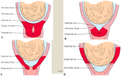 <p>the gradual thinning, shortening, and drawing up of the cervix measured in percentages from 0-100%</p>