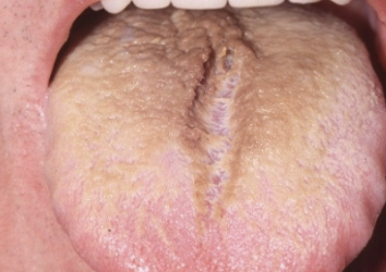 <p>stain is from food/ drink stains, chromogenic bacteria, may cause halitosis </p>