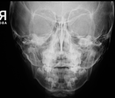 <p>modified water’s facial bones view demonstrates:</p>