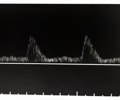 <p><span>What would be the significance of finding this waveform in a peripheral artery?</span><br><br><span>A. Blood is flowing into a low-resistance vascular bed rather than the expected high-resistance bed</span><br><br><span>B. The arterioles of the distal vascular bed are vasoconstricted</span><br><br><span>C. This waveform is consistent with a distal occlusion</span><br><br><span>D. This flow pattern suggests a proximal arteriovenous fistula</span></p><p></p>