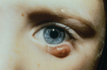 <p>What is the illness script of an internal hordeolum?</p>