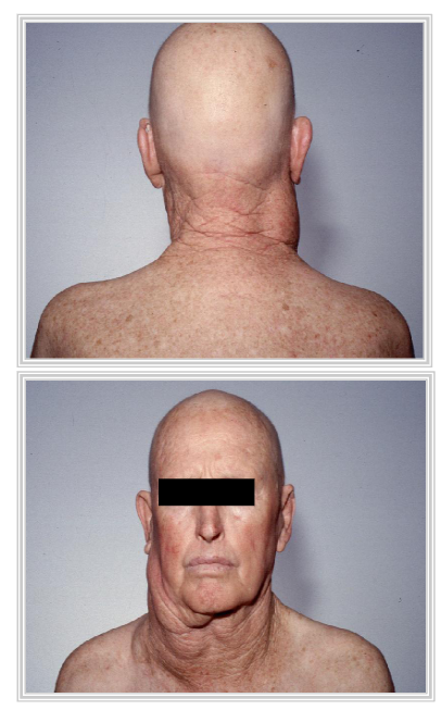 <p>Clinical Features of NHL</p>