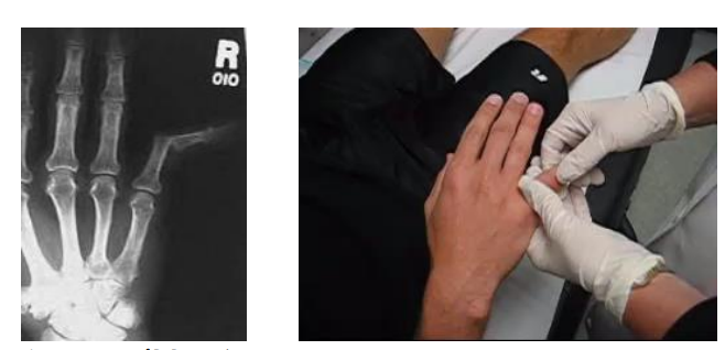<p>Ulnar PIP dislocation</p>