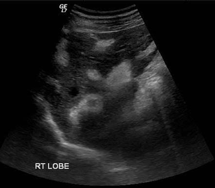 <p>increase echogenicity of portal walls, thick gb wall</p>