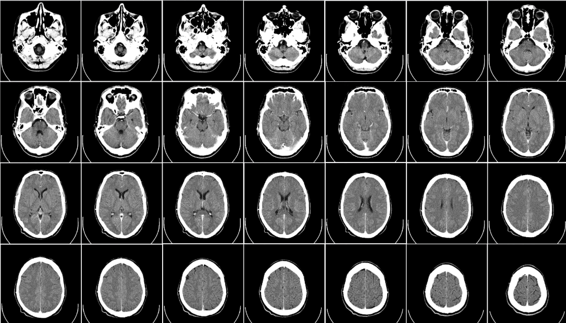 <ul><li><p><strong><u>X-rays </u>of the head generate images that may locate brain damage</strong></p><ul><li><p>a series of X-ray photos taken from different angles + combined by computer into a composite representation of a slice of the brain’s structure</p></li></ul></li></ul><p></p>