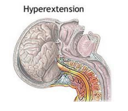 <p>anterior longitudinal ligament (would tear if stretched to far)</p>