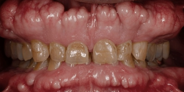 <p>localized bony protuberance that arise from the cortical plate; may be due to stress placed on the bone </p>