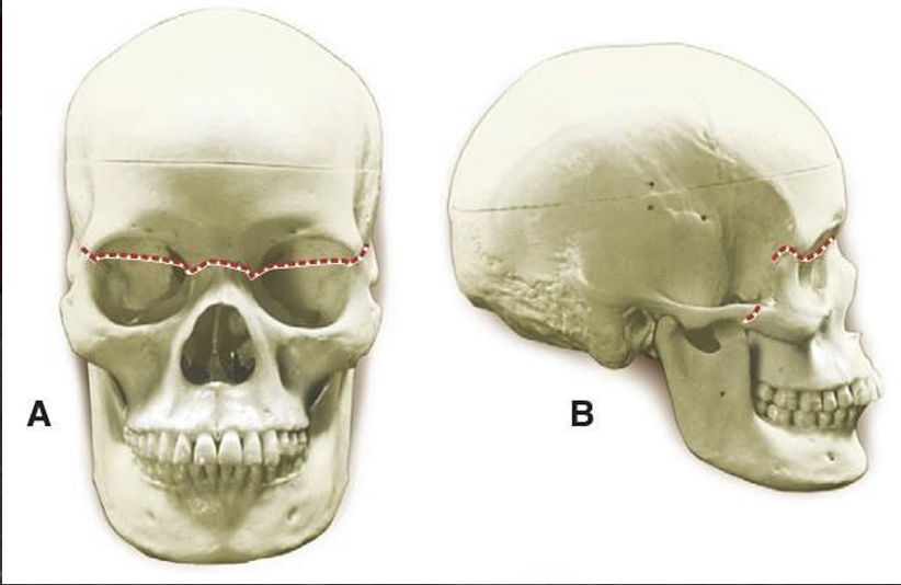 <p>craniofacial disjunction</p>