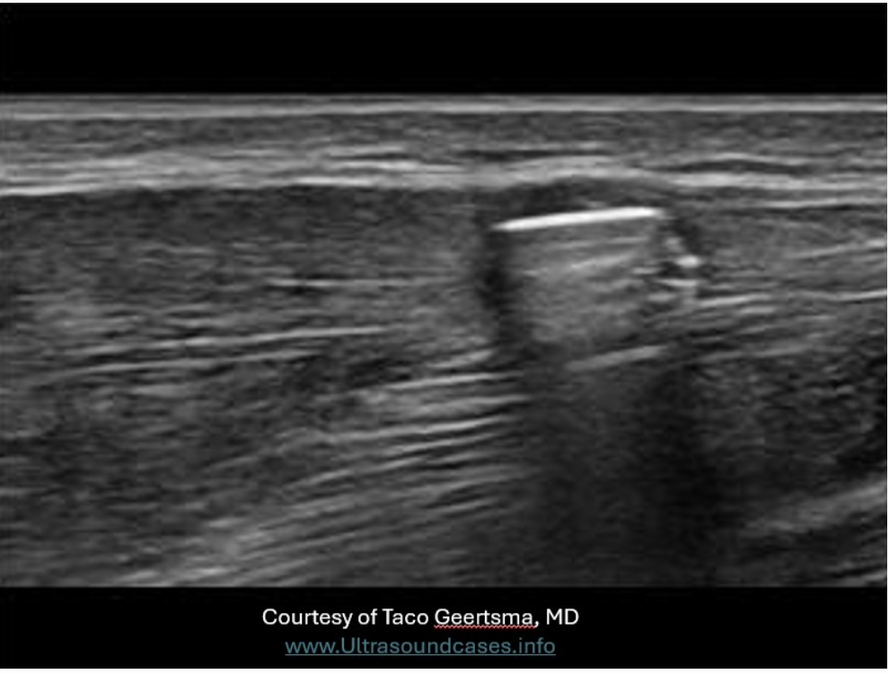 <p>The foreign body on the image is located in what tissue layer of the upper arm?</p><p>A. hypodermis</p><p class="p1">B. dermis</p><p class="p1">C. muscle</p><p class="p1">D. epidermis</p>