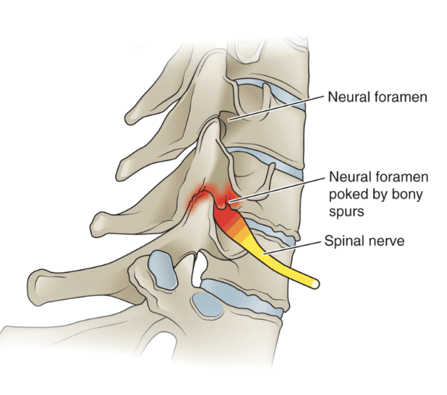 <p><em>OA or DJD in neural foramen with osteophytes overgrowing in foramen & constricting spinal nerve → causing radiculopathy (“pinched nerve”)</em></p><ul><li><p><strong>Pain</strong> :</p><ul><li><p><strong><u>Centralization :</u></strong> When distal pain moves closer to spine (GOOD!!!) </p></li><li><p><strong><u>Peripheralization</u> : </strong>When distal pain moves further down arm (BAD!!!) </p></li></ul></li><li><p><strong>Causes</strong> : Aging OR accelerated hyper- or hypo-mobility </p></li><li><p><strong>Symptoms</strong> : Neck & UE pain, numbness/tingling, weakness, loss of reflexes </p><ul><li><p><em><mark data-color="yellow" style="background-color: yellow; color: inherit;">!! Usually decrease in pain with neck flexion & shoulder ABD (placing arm overhead)!!</mark></em></p></li></ul></li><li><p><strong>Special Tests</strong> : </p></li></ul><ol><li><p>Spurling’s Compression Test </p></li><li><p>Cervical Distraction Test</p></li><li><p>Upper Limb Tension Test (ULTT) </p></li></ol><p></p>