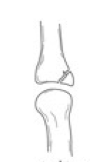 <p>Avulsion Fracture</p>