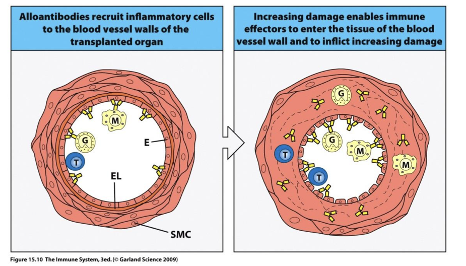 <p>thickening vessel walls and narrowing lumen → decreases blood flow to organ which eventually dies</p><p></p><p>→ some DC die in the lymph node → pieces of cells taken up by recipient DC in LN and AG (donor cells) presented on recipient HLA 2 → TH2 B cell response in donor tissue → Ab produced → obstruction over time</p><p></p><p>→ cause of 50% of failure of kidney and heart transplants within ten years</p><p></p>