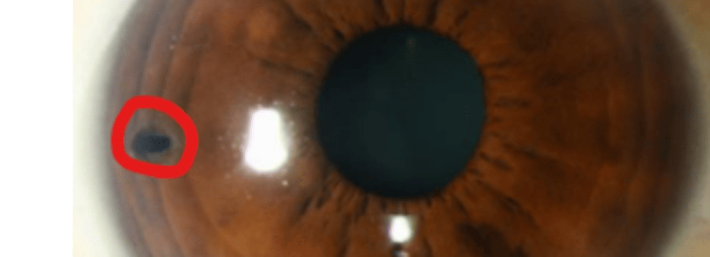 <p>the definitive treatment of acute primary angle closure WITH PUPIL BLOCK. Works best for patient with early synechiae development. Patient having chronic PAS or glaucoma optic neuropathy respond poorly and may need further treatment. </p>