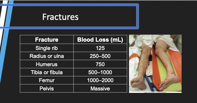 <ul><li><p><span style="background-color: transparent;">Major or multiple fractures can lead to significant blood loss.</span></p></li></ul><p><strong><br></strong></p><ul><li><p><span style="background-color: transparent;">Femur or pelvic fractures are the most common cause.</span></p></li></ul><p><strong><br></strong></p><ul><li><p><span style="background-color: transparent;">Don’t underestimate blood loss due to multiple other fractures.</span></p></li></ul><p></p>
