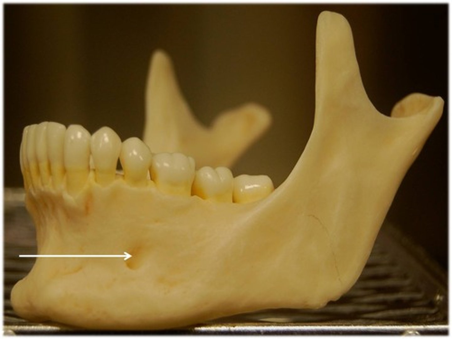<p>opening in the mandible for passage of chin artery/nerve</p>