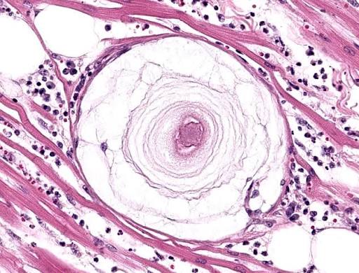 <p>"Onion skin" protozoal cysts</p>