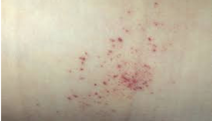 <ul><li><p>small hemorrhagic spots that cannot be blanched by diascopy or pressure</p></li></ul><p></p>