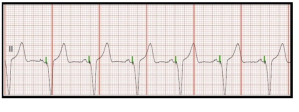 <p>The identification of the above ECG is:</p><p>a. Atrial pacing </p><p>b. Ventricular pacing </p><p>c. AV sequential pacing </p><p>d. Failure to sense</p>