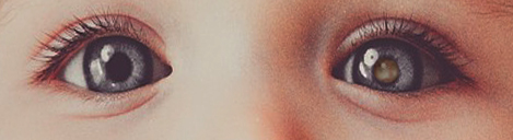 <p>Unilateral leukocoria eye appearance</p>