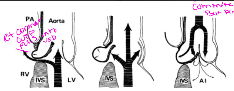 <ul><li><p>They are highly associated with aortic valve prolapse, about <strong>60–70%</strong>.</p></li><li><p>They are associated with aortic insufficiency.</p></li><li><p>They may be seen with malalignment VSDs.</p></li></ul><p>(ventri effect)</p>