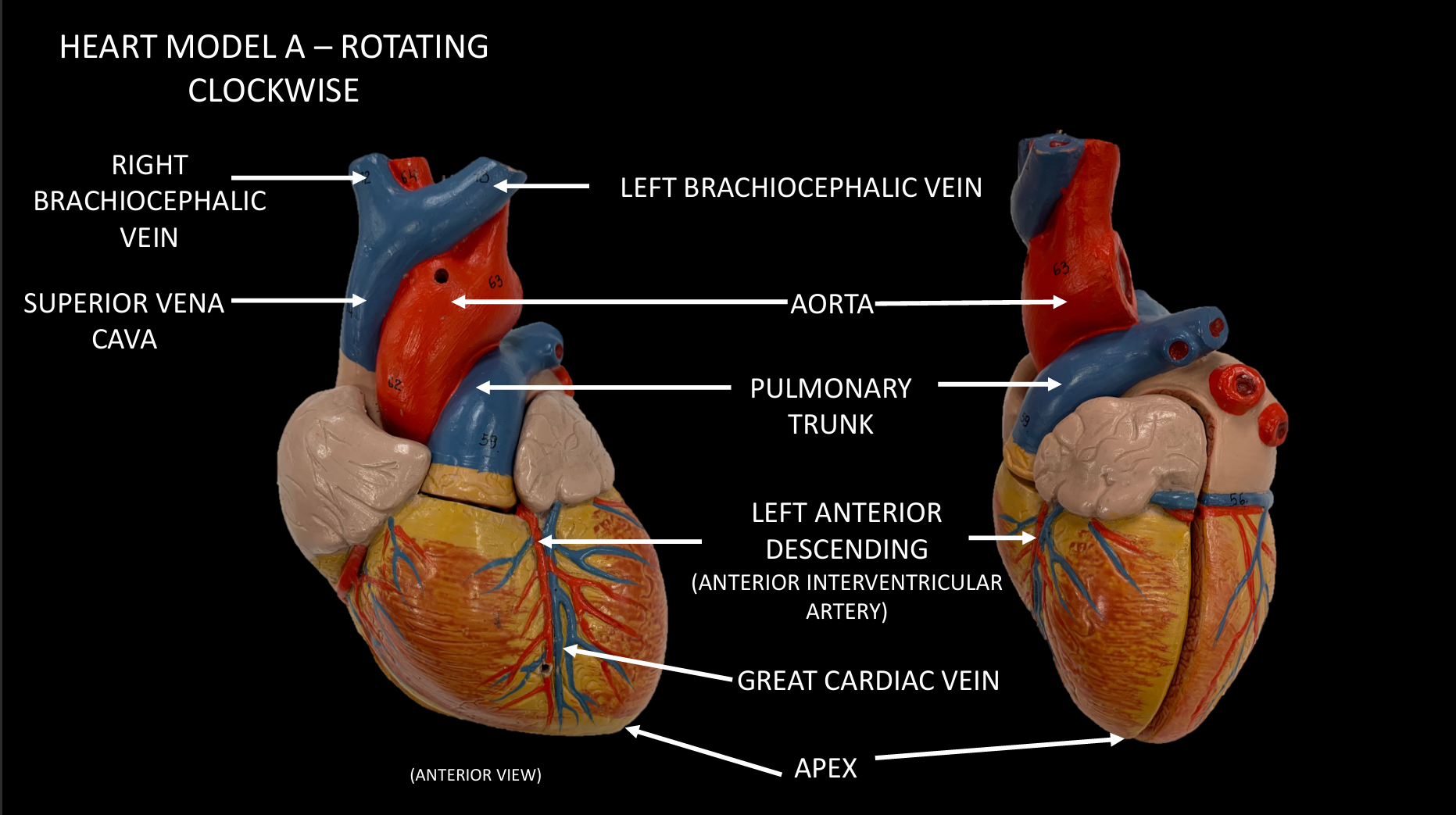 <p>ANTERIOR INTERVENTRICULAR ARTERY (LEFT ANTERIOR DESCENDING)</p>