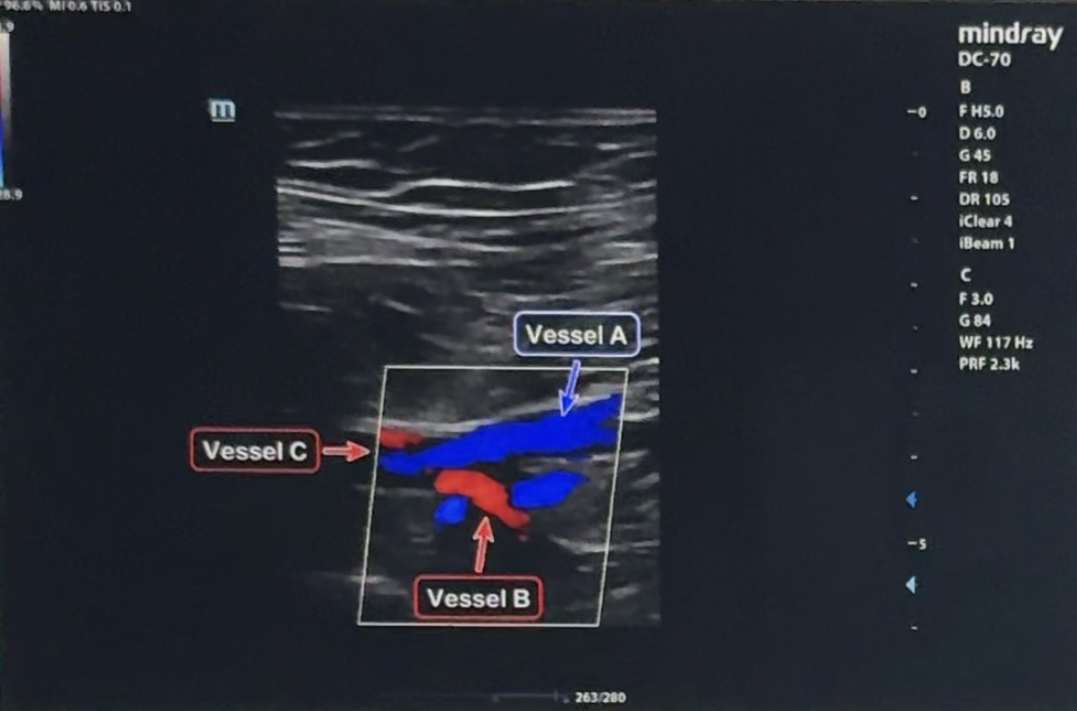 <p>A sonographer identifies Vessel A and Vessel B.</p><p>Which statement is most accurate?</p>