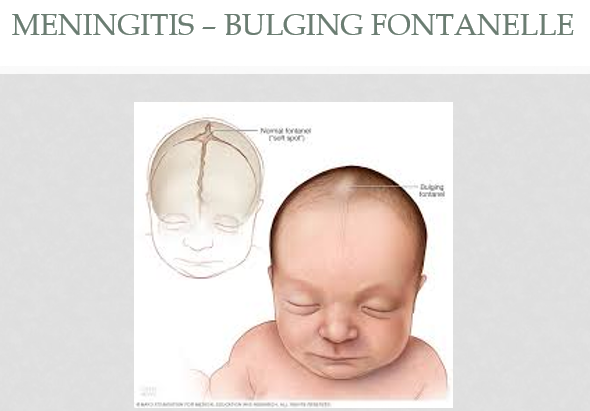<ol><li><p>feeding intolerance </p></li><li><p>apnea</p></li><li><p>bulging fontanelle</p></li></ol><p></p>