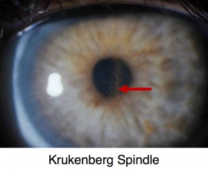 <p>A Krukenberg spindle is vertically oriented pigment accumulation on the posterior corneal endothelium from liberated iris pigment circulating in the aqueous.</p>