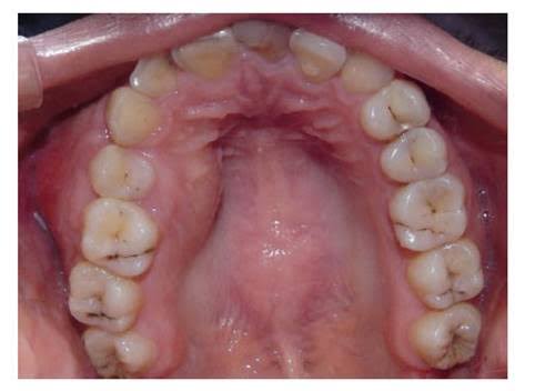<p><span><span>Dolor y expansión ósea localizada.</span></span></p>
