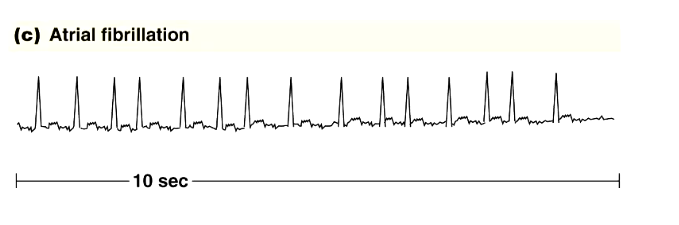 <ul><li><p>atria do not contract as a unit</p></li><li><p>usually not a problem as the majority of ventricular filling happens passively, the atrial contraction only squeezes the last bit out</p></li><li><p>only issue is if blood gets caught in pockets in the atria, it can turn into clots hich can enter the coronary artery and cause a stroke</p></li></ul><p></p>