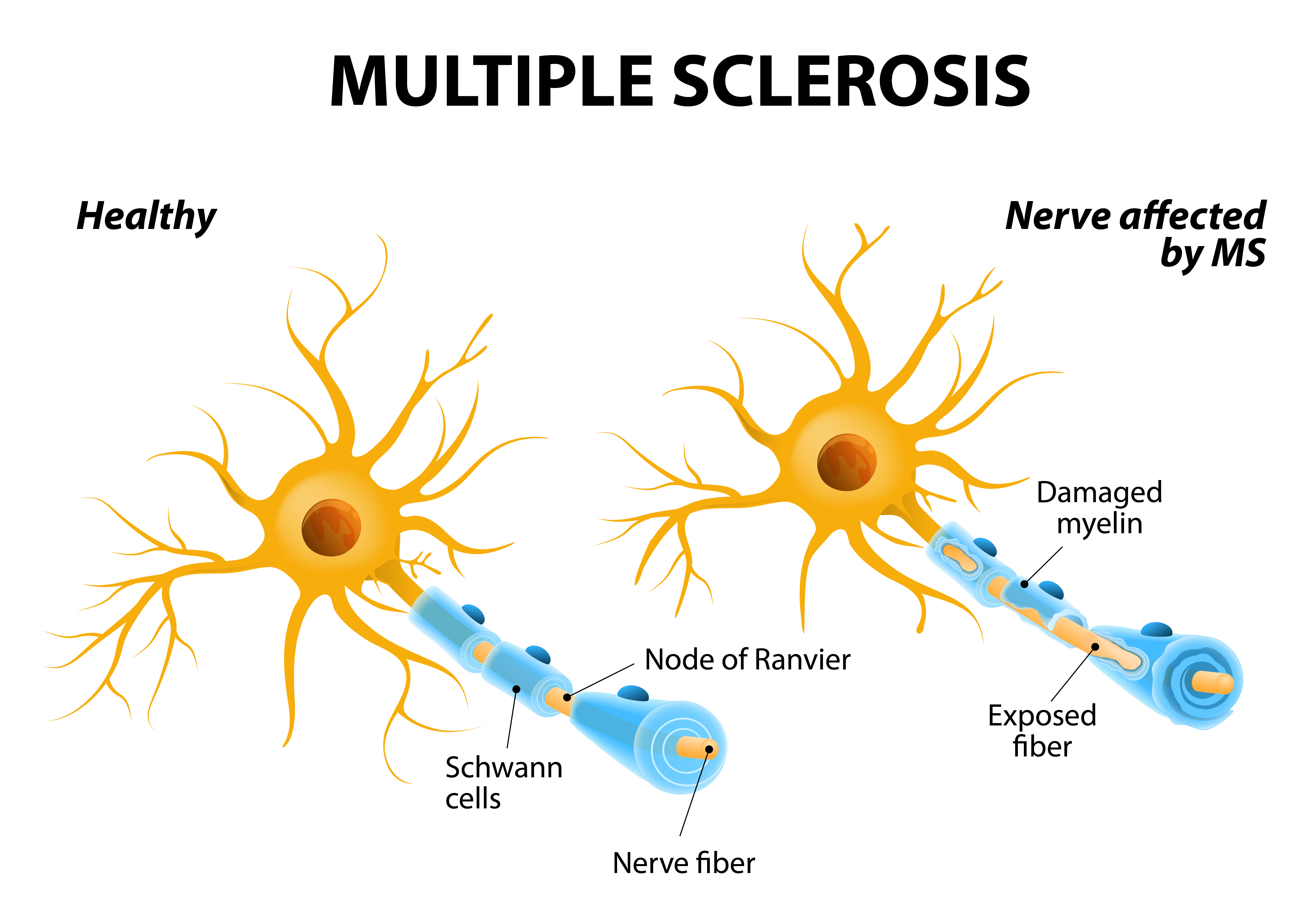 <p>Symptoms of Multiple Sclerosis</p>