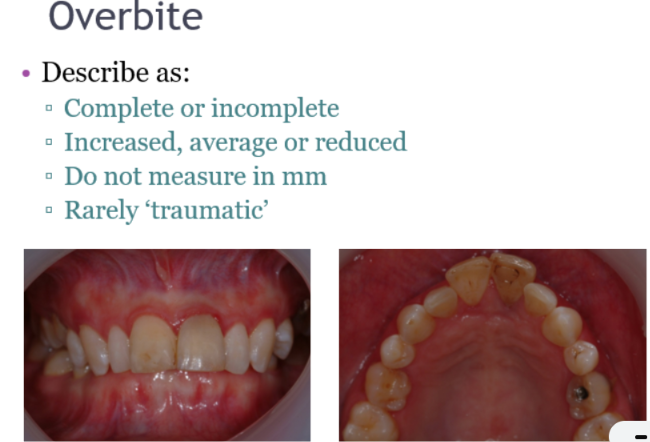 <p>complete (to palatal mucosa) increased overbite - traumatic as there is indentation of the mower incisors on the palate </p>