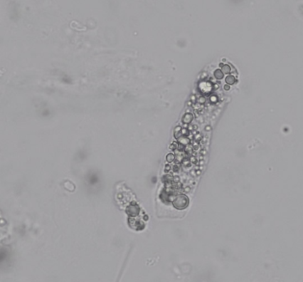 <p><strong>Fatty casts</strong> (along with highly elevated protein and oval fat bodies).</p>