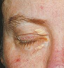 <p>Slightly raised, yellowish, well-circumscribed cholesterol-filled plaques along upper/lower nasal portions of 1 or 2 eyelids</p><p>½ have hyperlipidemia; common w/ biliary cirrhosis</p>