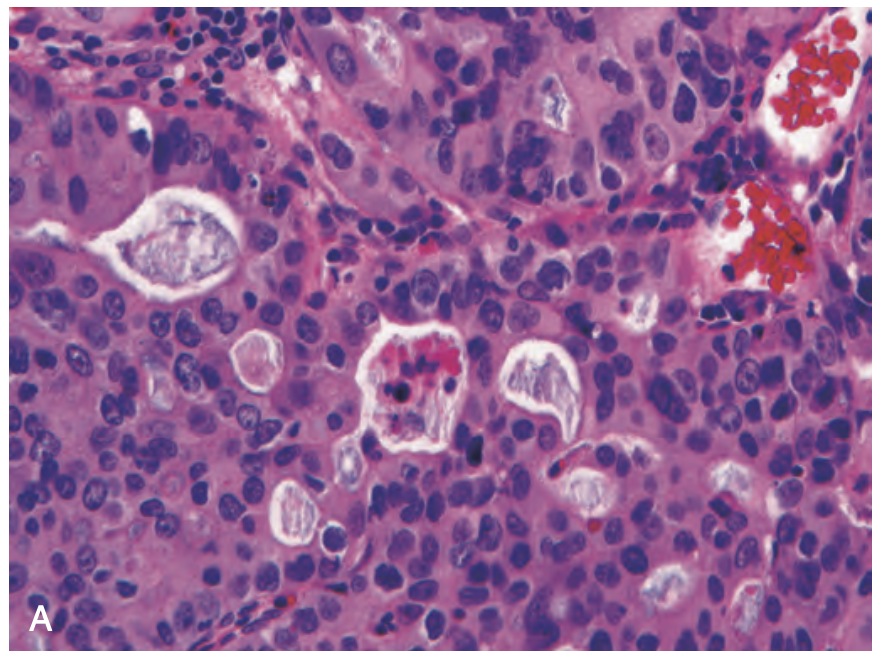<p>diagnosis, esophageal tumor</p>