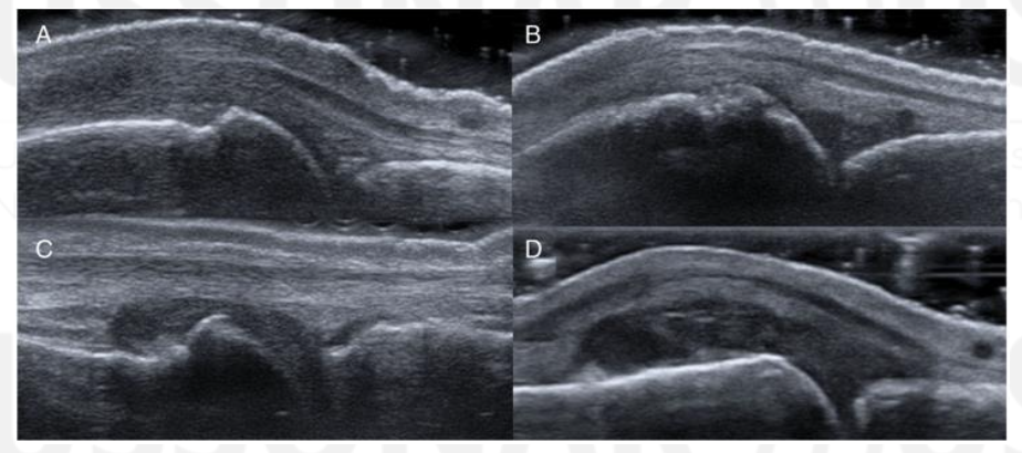 <p>Grade The Synovial Hypertrophy</p>