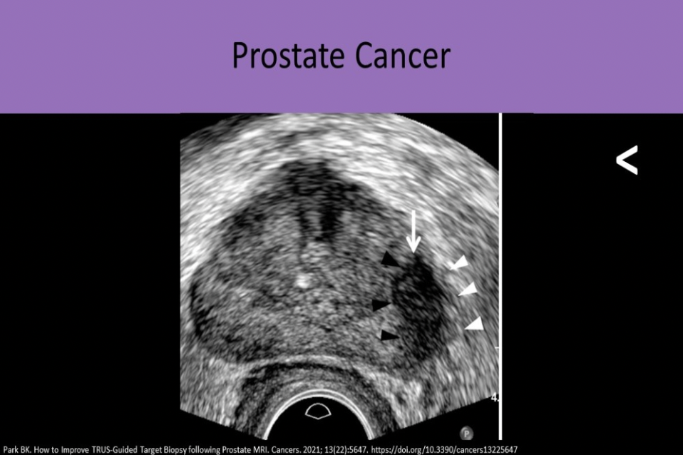 <p>A. Adenocarcinoma</p>