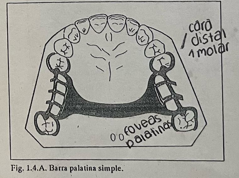 <p><span>Zona edentula más anterior no se puede: aumenta el volumen,puede resultar incómoda,disminuye larigidez de la prótesis.</span></p><p><span>● Prótesis dentosoportadas de brechas posteriores cortas.</span></p><p><span>● Clase II con extremo libre,buen soporte mucoso y reemplazo de 1–2 dientes o oclusión</span></p><p><span>antagonista débil.</span></p>