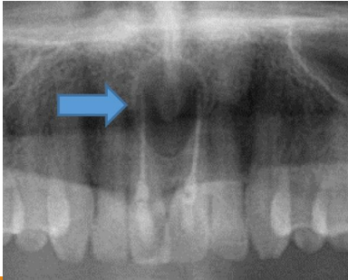 <p>A 52 year old presenting with a cystic swelling in midline in the anterior region of palate. Provide differential diagnosis</p>