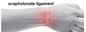 <ul><li><p>Pain, tenderness, on dorsum of joint </p></li><li><p>Increase pain between scaphoid and lunate increases with active or passive extension. </p></li><li><p>Remember that scaphoid fractures may not show immediately on X-ray</p></li></ul><p></p>